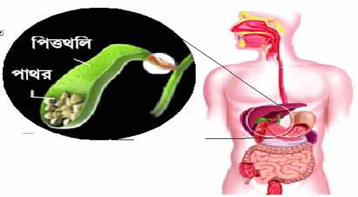 কীভাবে বুঝবেন পিত্তথলিতে পাথর জমেছে