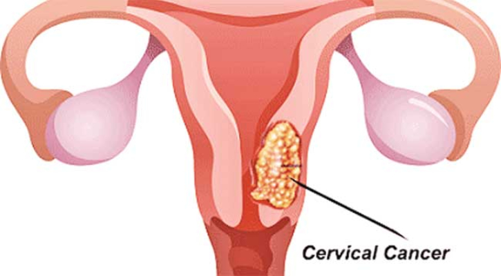 জরায়ুতে ক্যানসার যে কারণে হয়